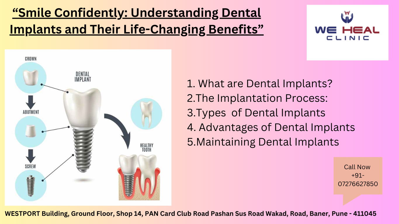 Understanding Dental Implants and Their Life-Changing Benefits"