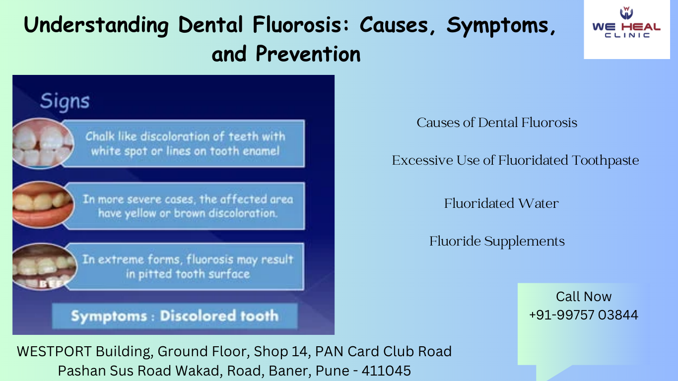 Understanding Dental Fluorosis