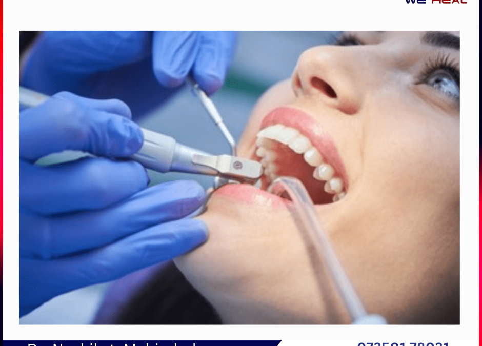 Root Canal Specialist in Baner