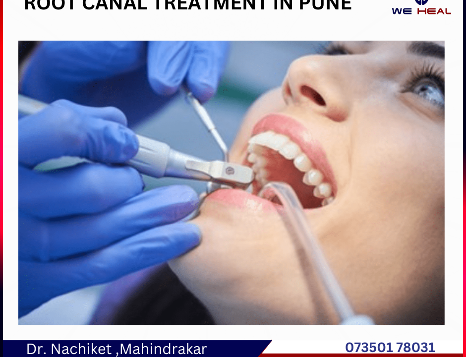 Root Canal Specialist in Baner