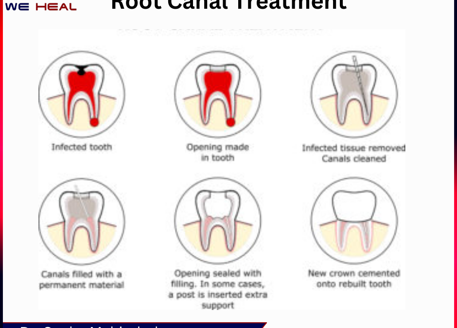 Root Canal Treatment