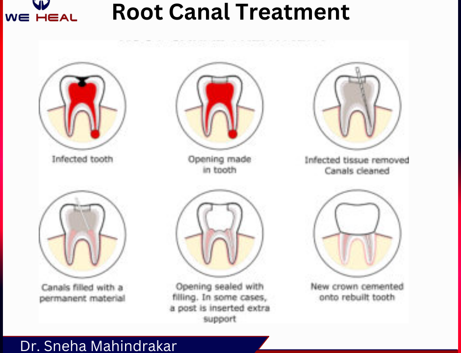 Root Canal Treatment