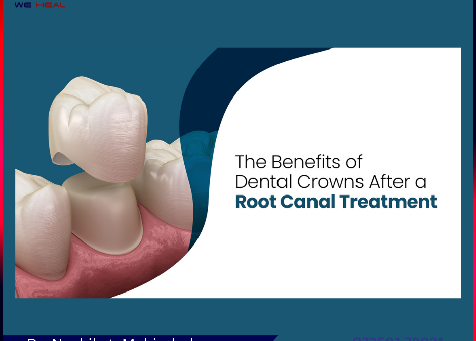 5 Benefits from Dental Crown After Root Canal Treatment