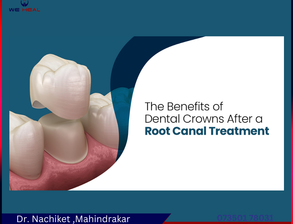 5 Benefits from Dental Crown After Root Canal Treatment