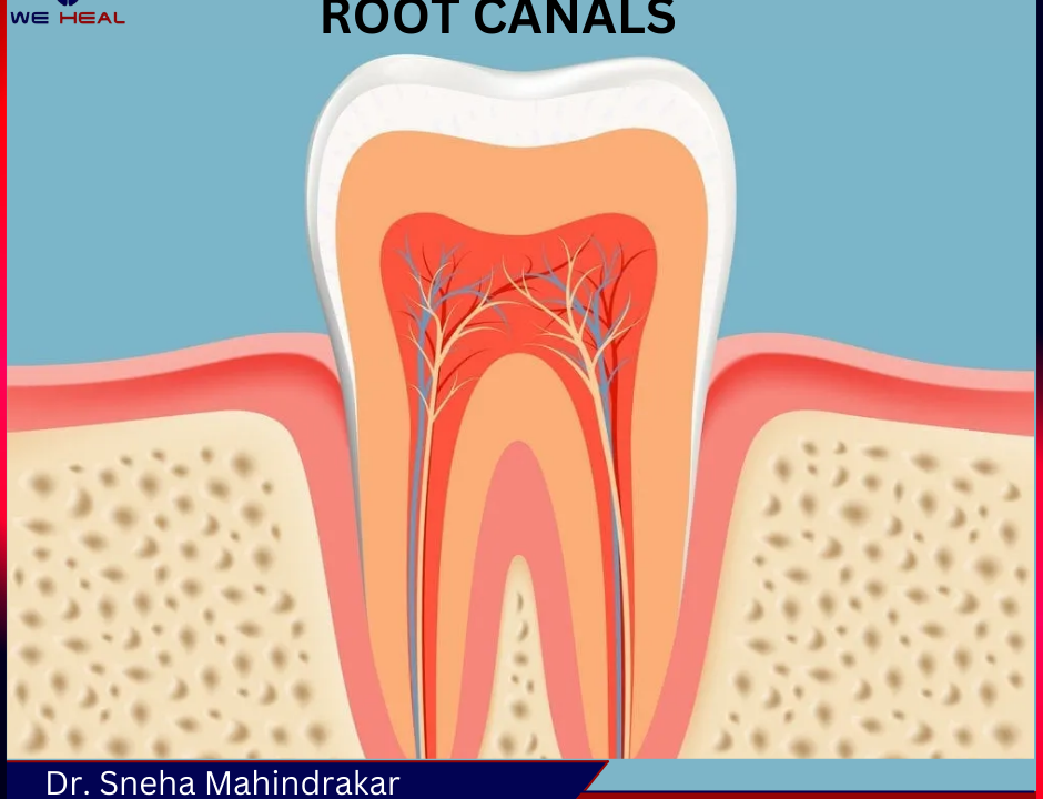 Root Canal Specialist in Baner