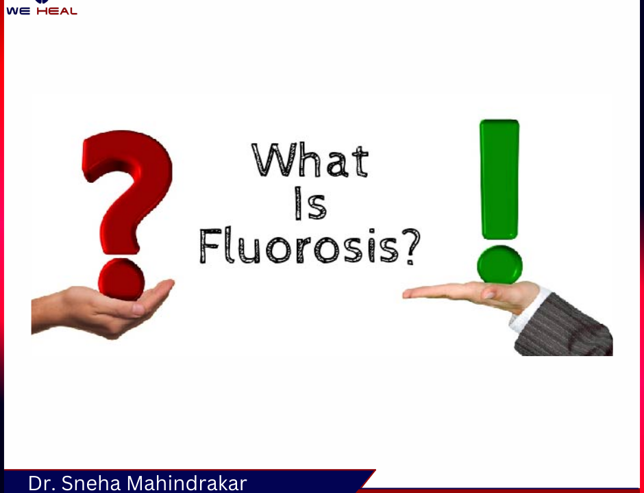 Dental Fluorosis