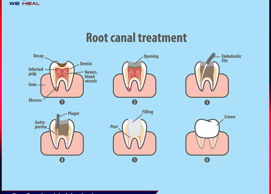 Root Canal Specialist in Baner