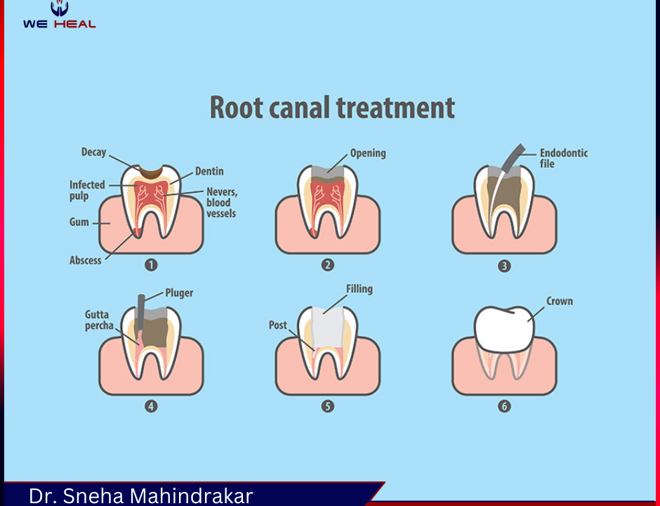 Root Canal Specialist in Baner