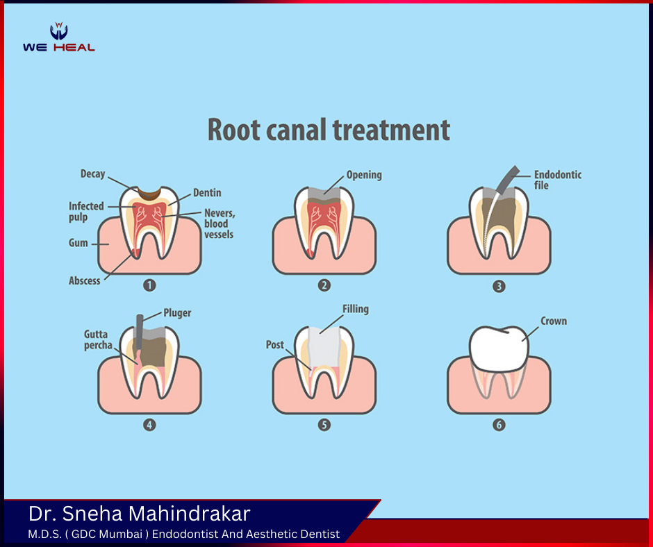 Root Canal Specialist in Baner