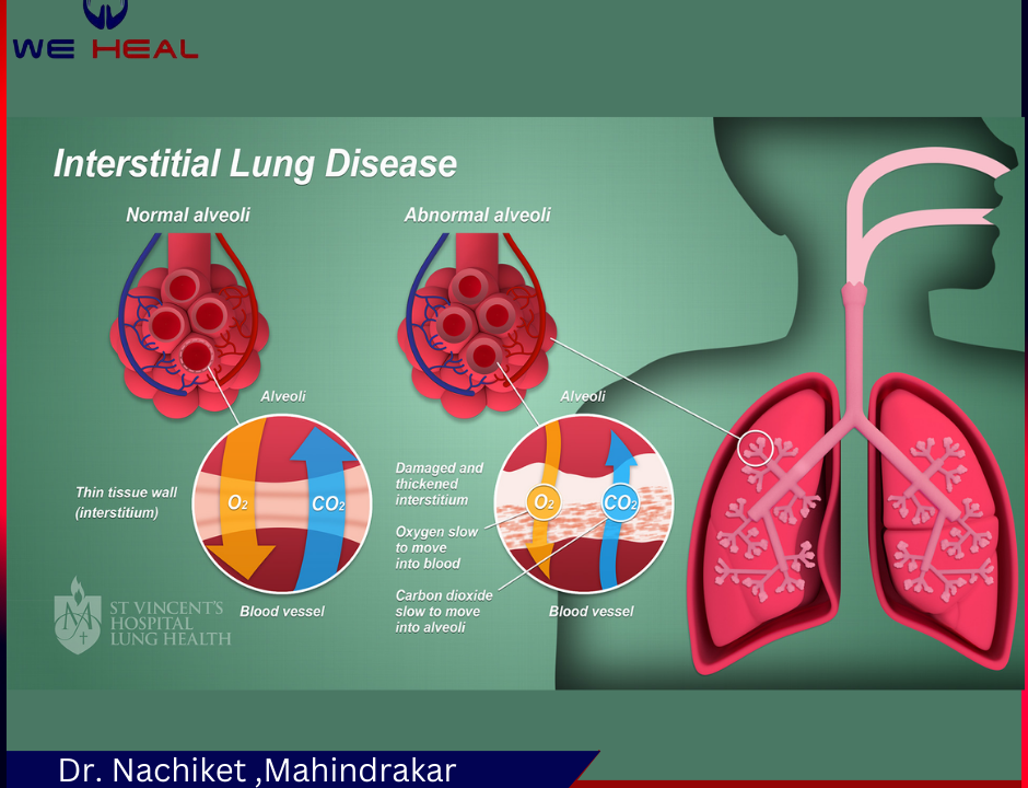 Lung Disease