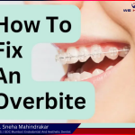 Overbite