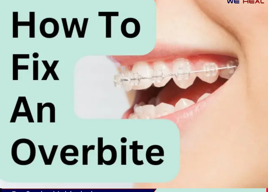 Overbite