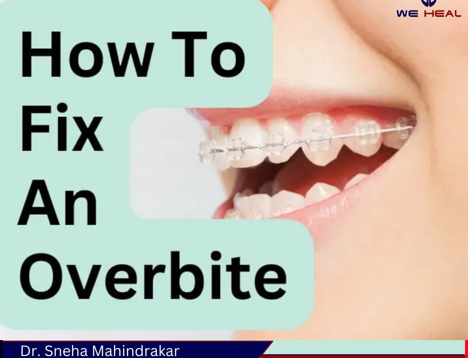 Overbite