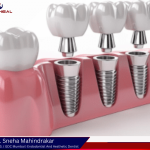 Dental Implants Treatment in Pune