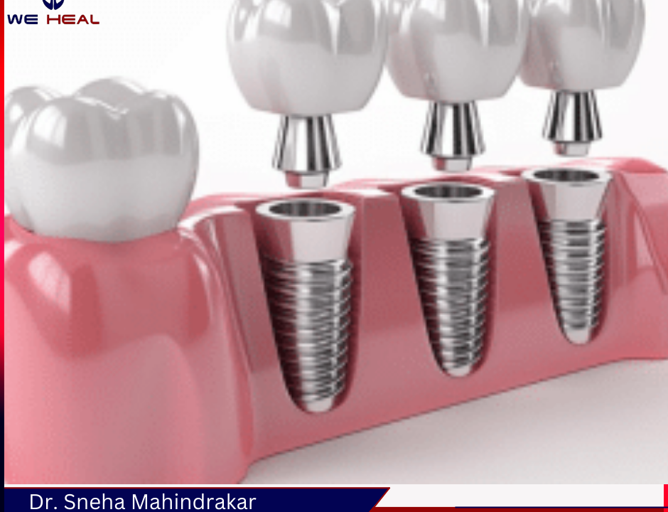 Dental Implants Treatment in Pune