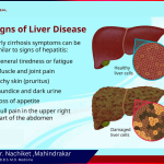 Signs of Liver Disease