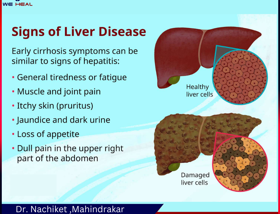 Signs of Liver Disease