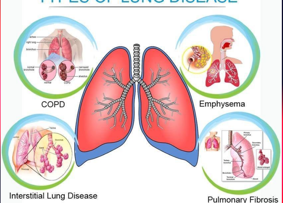 Types of Lung Disease Treatment in pune