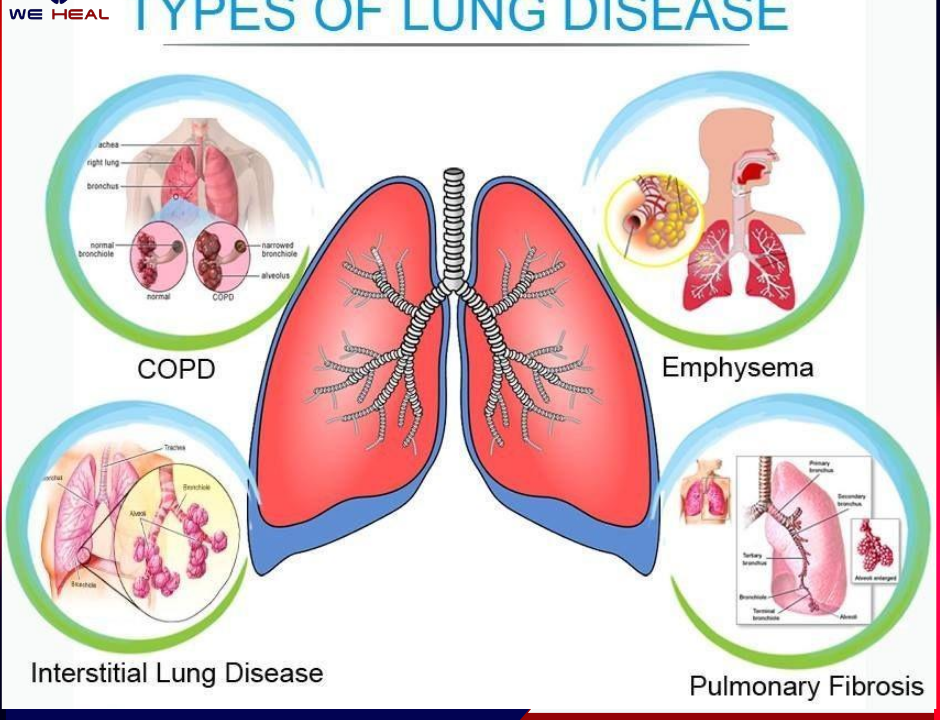 Types of Lung Disease Treatment in pune