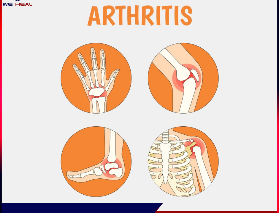 Arthritis Treatment in pune