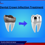 Dental Crown Treatmenet in pune