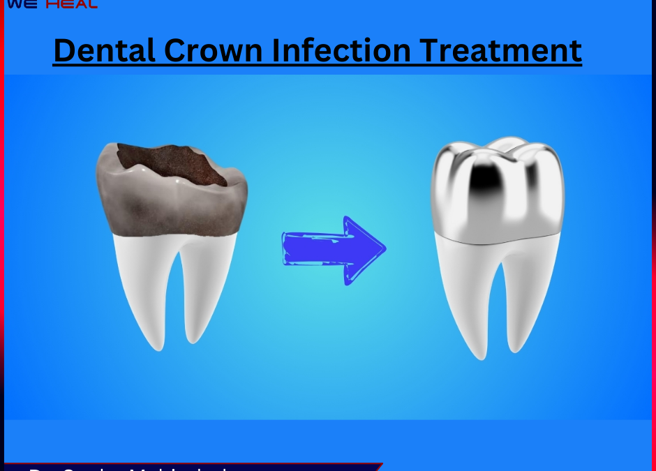 Dental Crown Treatmenet in pune