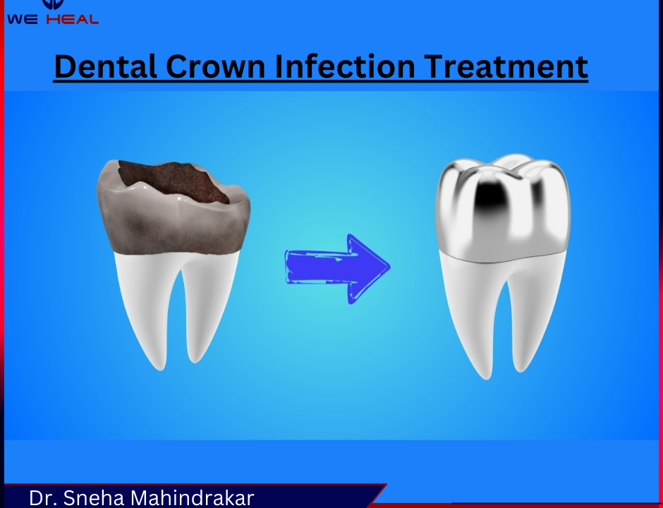 Dental Crown Treatmenet in pune